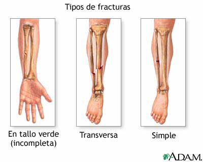 FRACTURAS